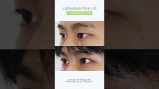 남자눈매교정 뒤트임밑트임 전후