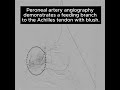 The TAME Lab: Achilles Tendinopathy Case 2