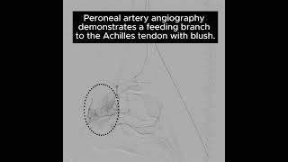 The TAME Lab: Achilles Tendinopathy Case 2