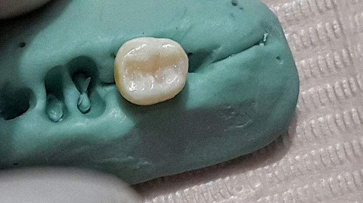 Class II Composite restoration  on a natural tooth for dental students