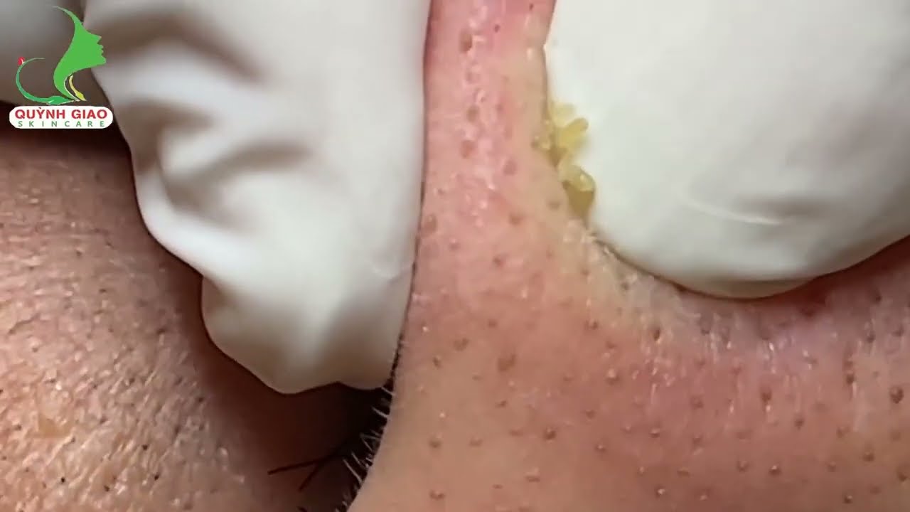 Brand new Original Pimple Popping videos 2023