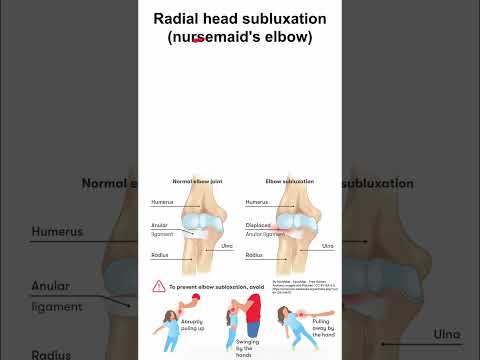 Radial head subluxation