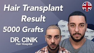 Hair Transplant Results With 5000 Grafts - Before And After Dr Emrah Cinik