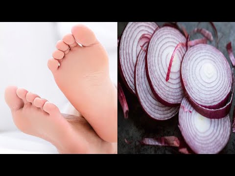 Attaching Sliced Onion To Your Foot Will Help Cure Your Illnesses Overnight!