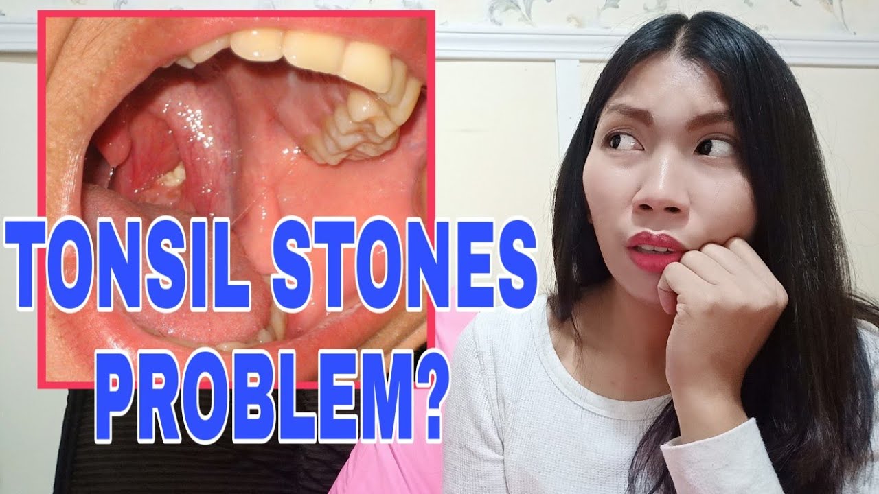 Natural Treatment For Tonsil Stones Tonsil Stones Removal Youtube