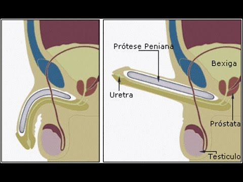 como aumentar erecao naturalmente