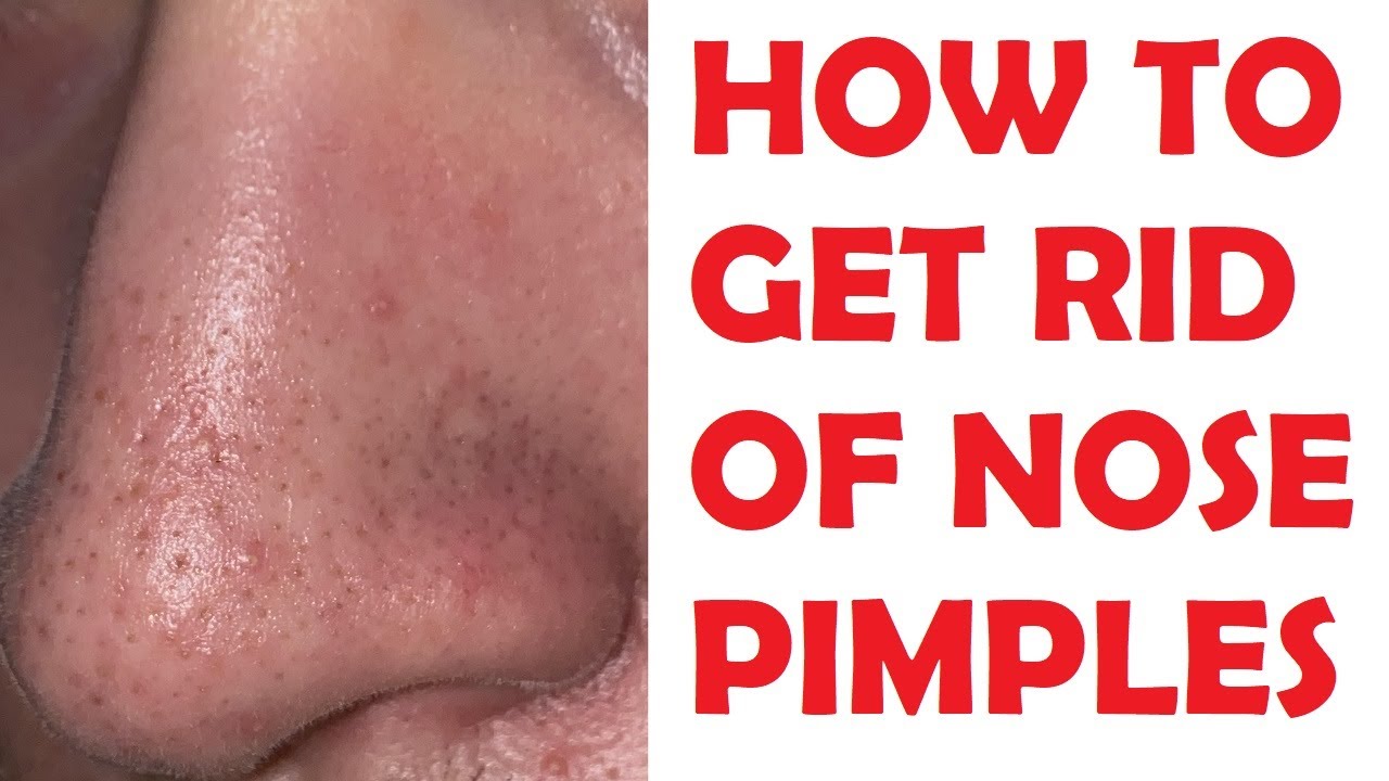 how-to-get-rid-of-nose-pimples-fast-at-home-youtube