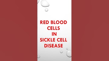 sickle cell Red blood cells in sickle cell anemia