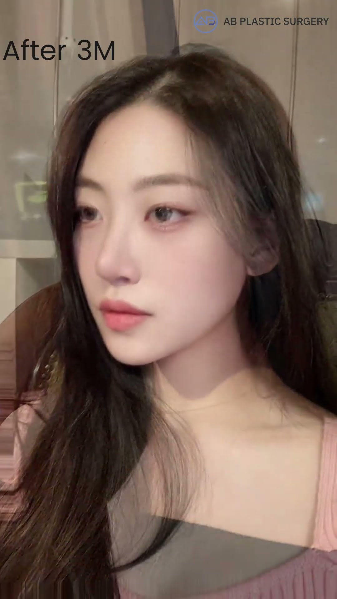 Revision Rhinoplasty Before&After #plasticsurgerykorea