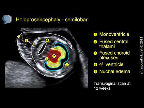 semilobar-holoprosencephaly:-2d-and-3d-ultrasound