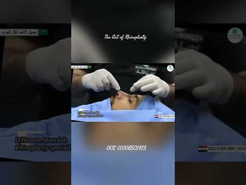 تجميل الانف السعودى مع د حسام ممدوح