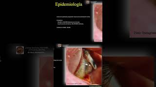 Epidemiologia del Queratocono.queratocono optometria oftalmologia cornea