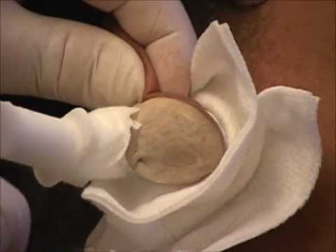 How to get rid of Earlobe Keloids - Keloid Removal - Keloid Treatment - Keloid Specialist. - YouTube