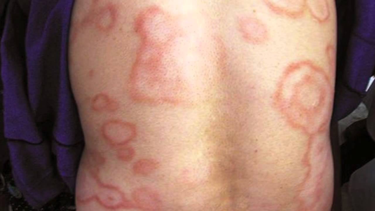 Heart Disease Skin Rash