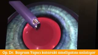 Dünyagöz Pendi̇k Hastanesi̇nde Bi̇r Katarakt Ameli̇yati Öyküsü