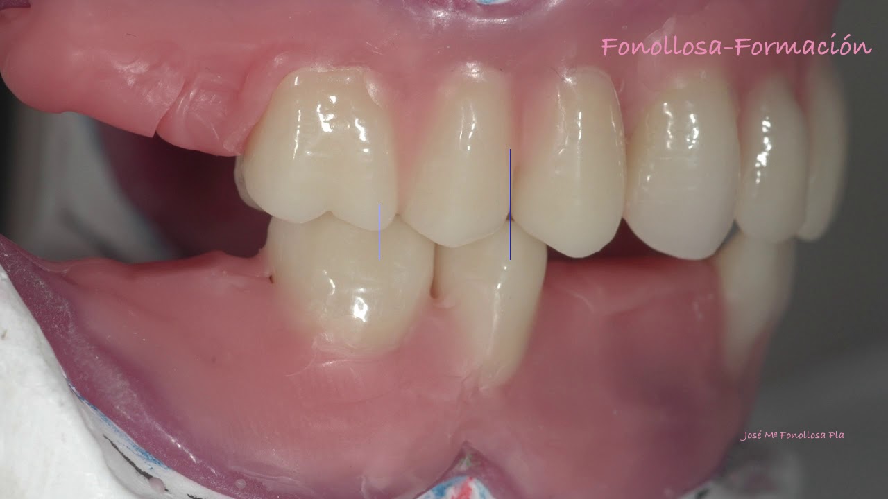 MONTAJE  DE DIENTES BIBALANCEADO