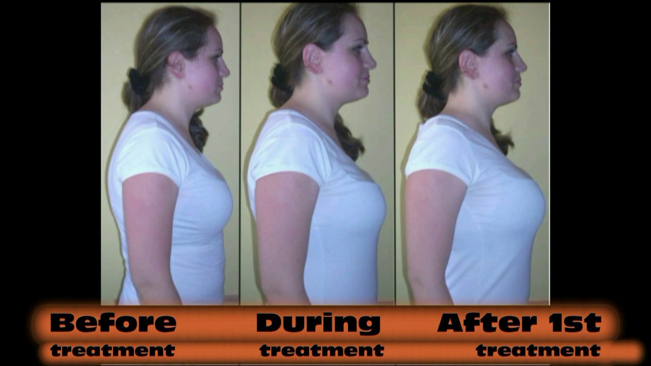 The effects of chiropractic: Bad posture, scoliosis, crooked back ...
