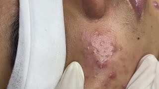 Relaxing Acne Treatment #76| she’s 15 years old screenshot 5