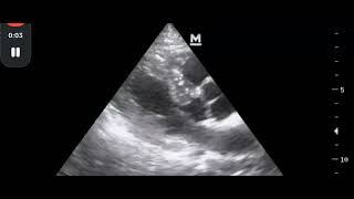 hyperdynamic lv pocus