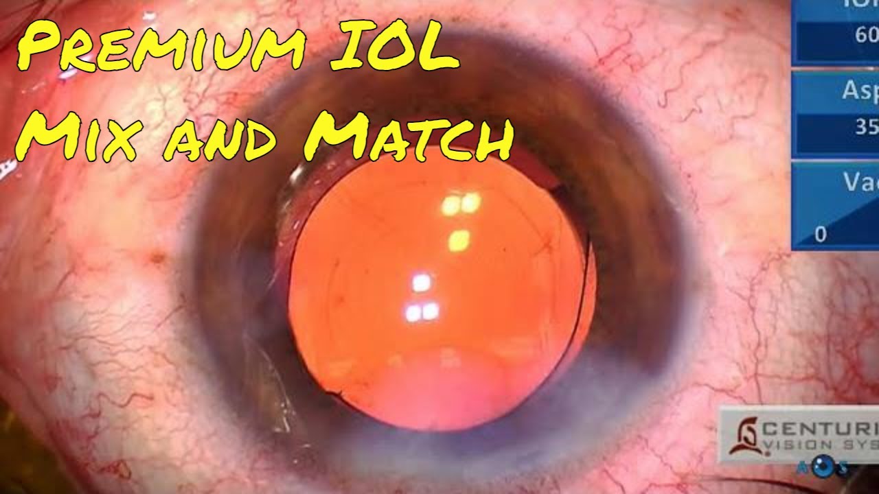 Refractive Surgery with Premium IOL Mix and Match of Vivity and