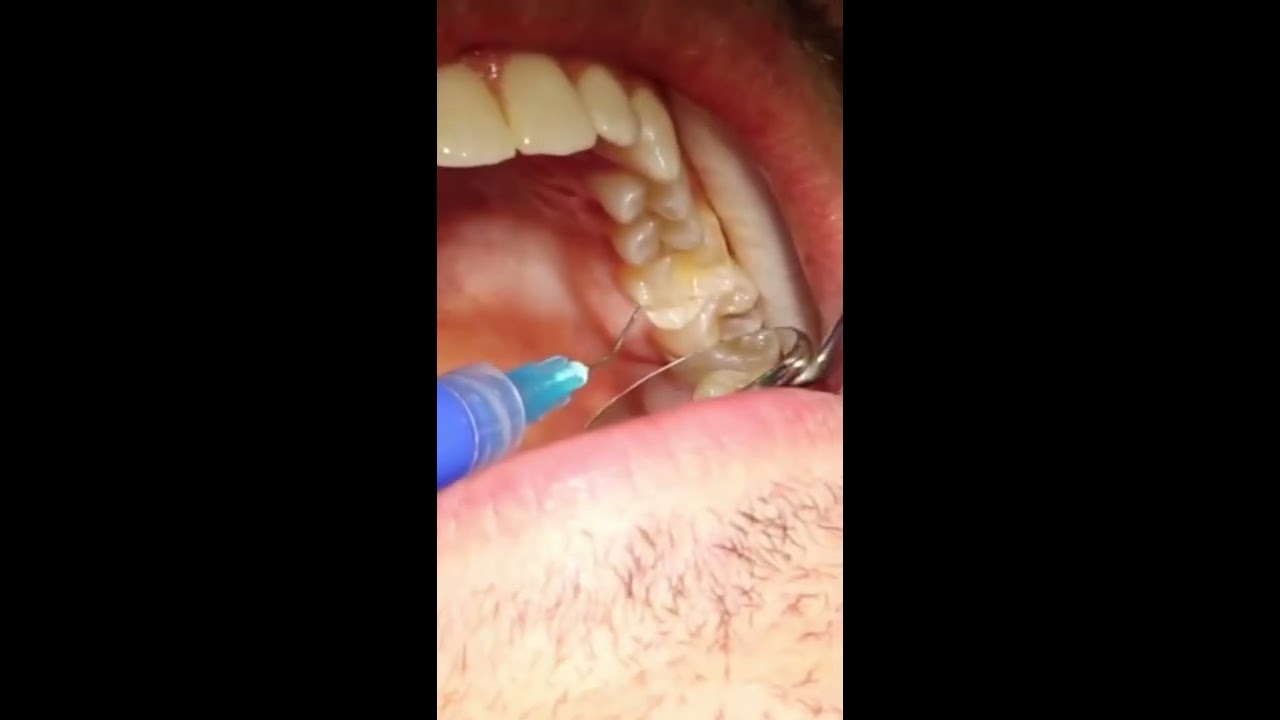 Hidden Cavity Under Tooth Shorts Decay Filling Procedure 
