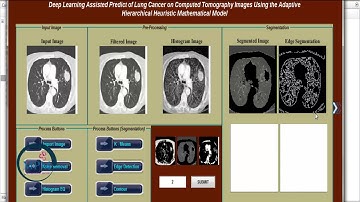Deep Learning Assisted Predict of Lung Cancer on CT Image Using Hierarchical pattern | MATLAB