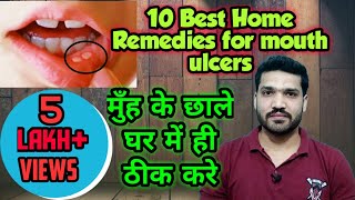 मुँह के छालों के 10 घरेलु इलाज । How to treat mouth ulcers at home ??