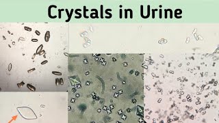 Calcium Oxalate Monohydrate Crystals || Calcium oxalate Crystals in urine || urine microscopy ||