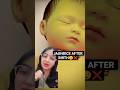 Why Do Newborn Babies Get jaundice?😲#shots