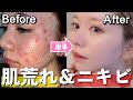 大量のニキビを治した私のスキンケアを紹介します！【肌荒れ改善】