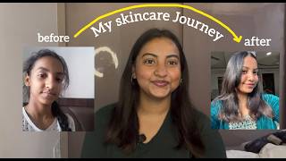 My Skincare Journey ( mistakes, routine, facing discrimination & a lot more)