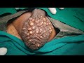 Derma touch live scrotal cyst surgery