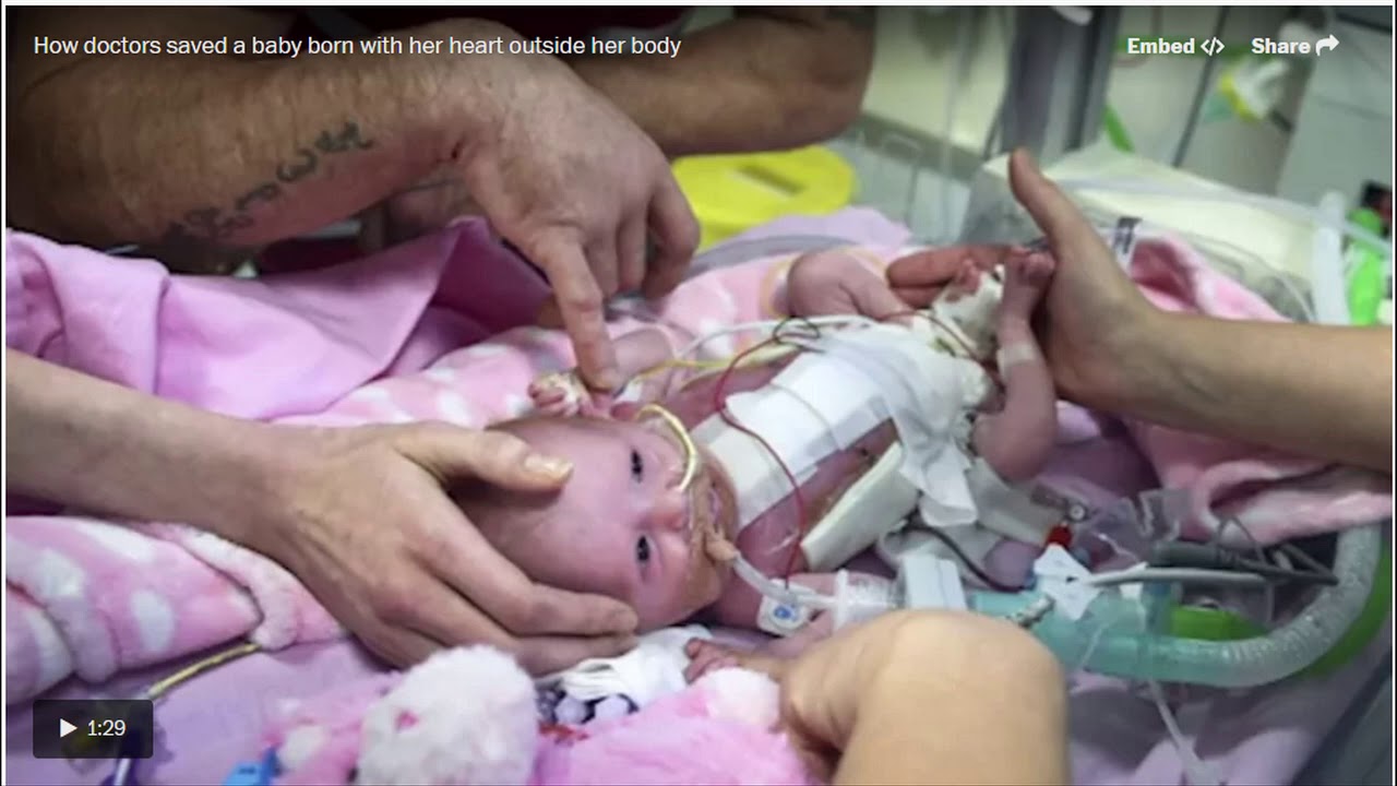 What Is Ectopia Cordis Baby Survives Being Born With Heart Outside Her
