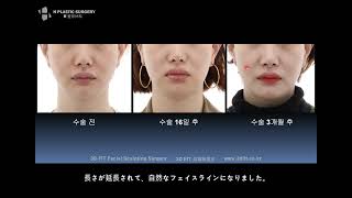 オトガイ手術（骨切り）後の陥没の副作用：エラの再手術（オトガイ再手術）のビフォーアフター