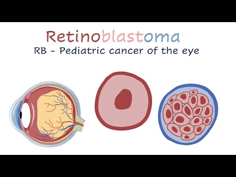 Retinoblastoma — video thumbnail