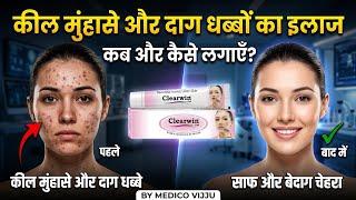 Treatment for pimples and dark spots | Clearwin Gel Ke Fayde aur Nuksan | Honest Review