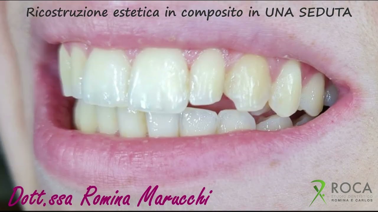 Ricostruzione Estetica in Composito