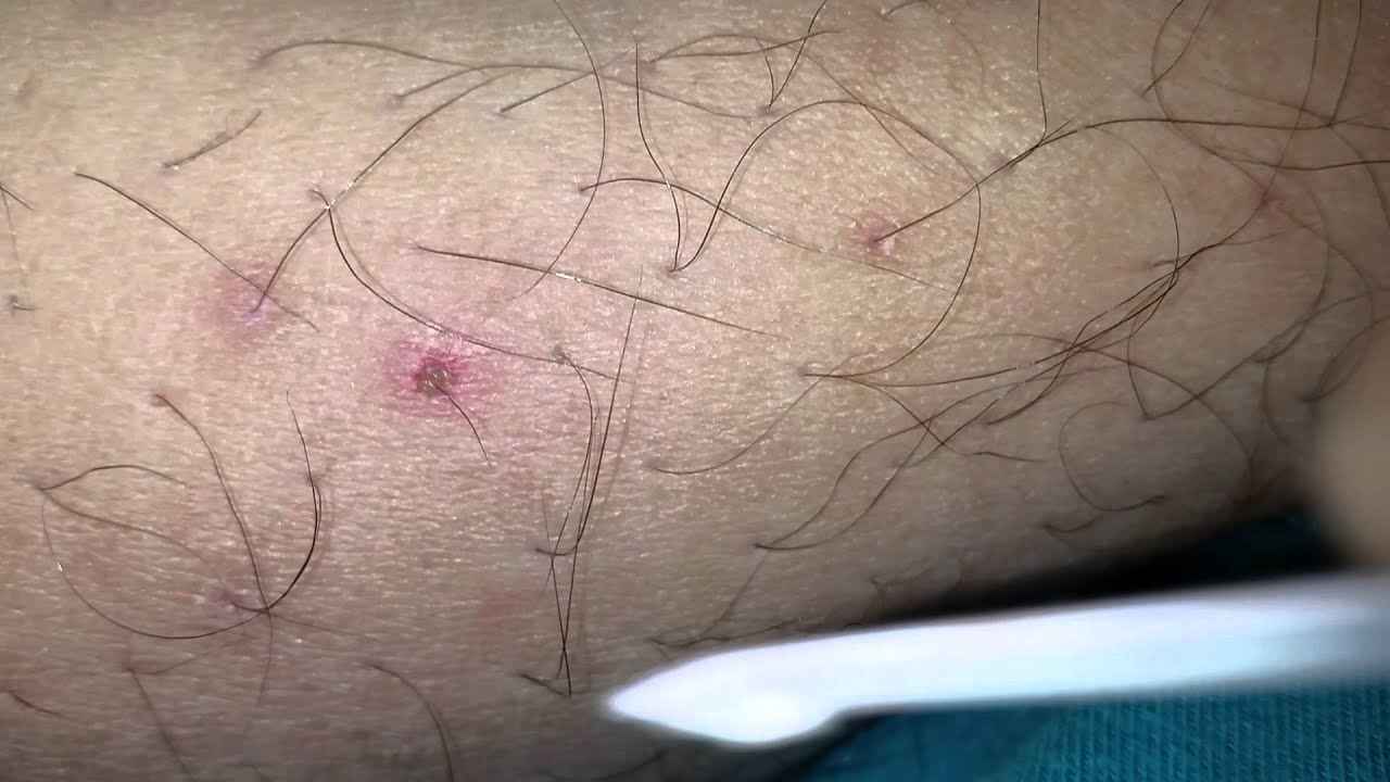 Ingrown Hair Pus Nasty Zit Youtube