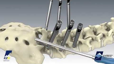 Stryker (K2M): EVEREST Minimally Invasive XT Spinal System Product Animation