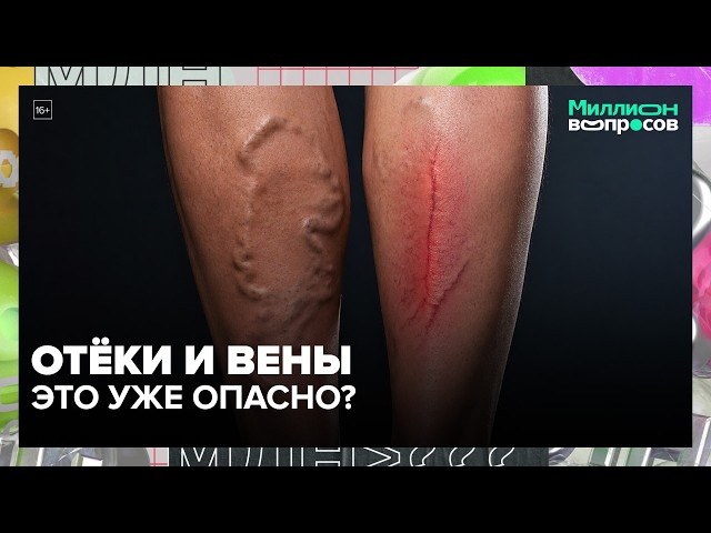 Вены, отёки и тромбоз: какие симптомы нельзя игнорировать | Миллион вопросов  Москва 24