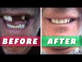 How to make home made false teeth  do it yourself dentures  fix a missing tooth  full tutorial