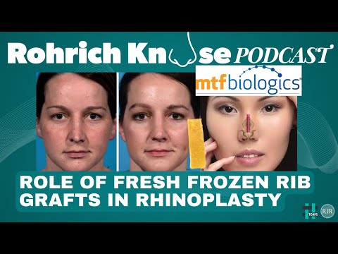 Video thumbnail: Role of Fresh Frozen Rib Grafts in Rhinoplasty
