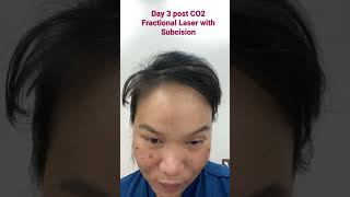 Day 3 post CO2 Fractional Laser with Subcision