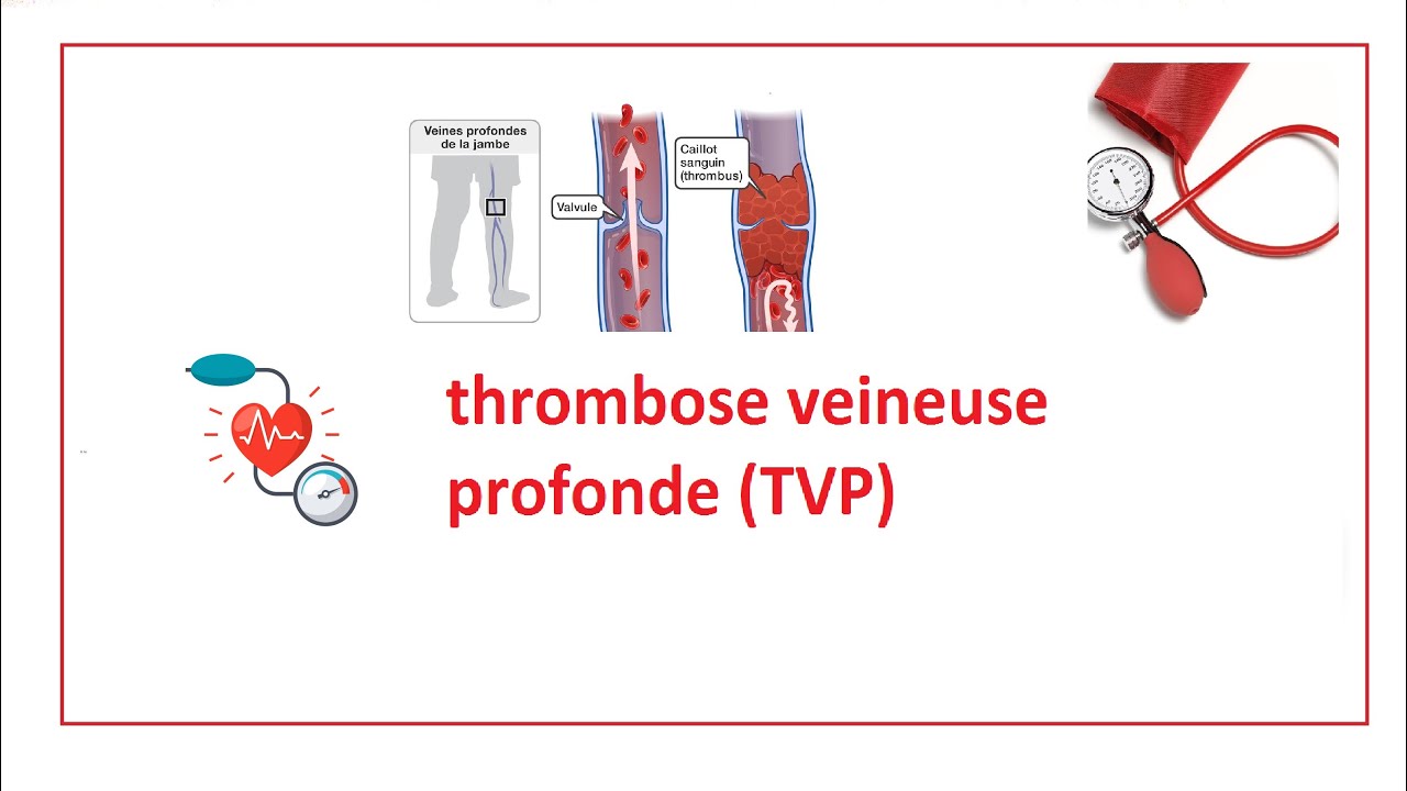 thrombose veineuse profonde TVP YouTube thrombose veineuse profonde TVP YouTube