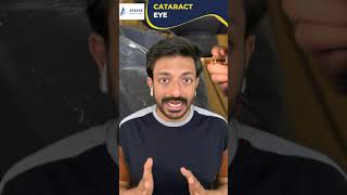 cataract eye | Aspire Education | PLAB2