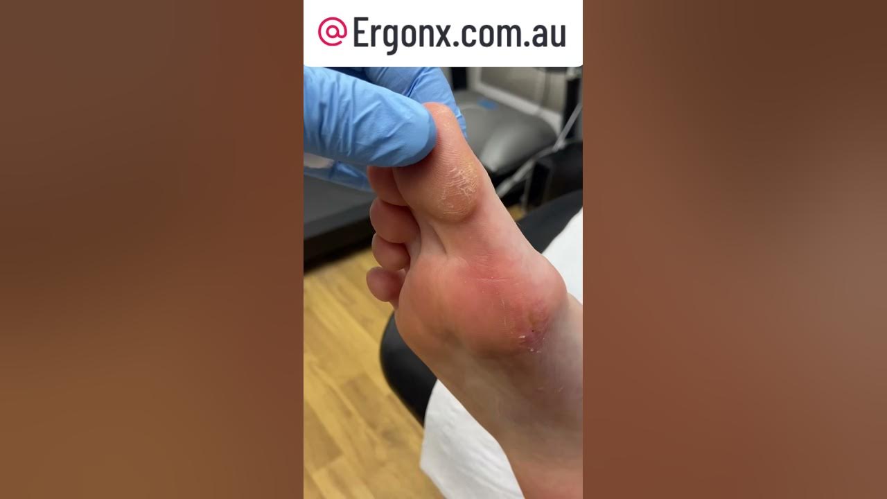 Thick skin and callus removal by a podiatrist in the podiatry clinic it