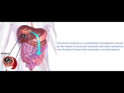 Vidéo: Syndrome Du Côlon Irritable Vs Syndrome Carcinoïde