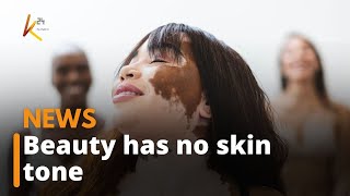 World Vitiligo Day in Kenya