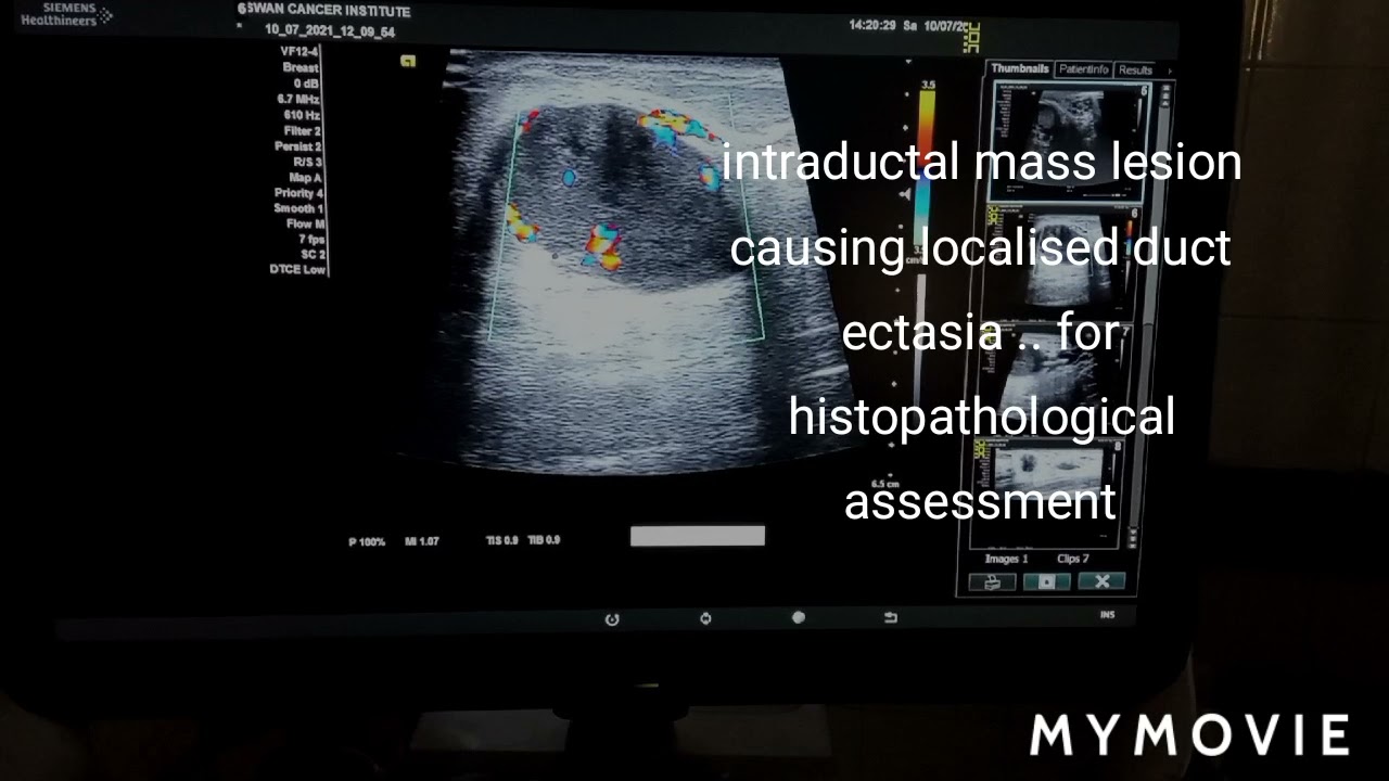 intra ductal mass causing localized duct ectasia • ultrasound case