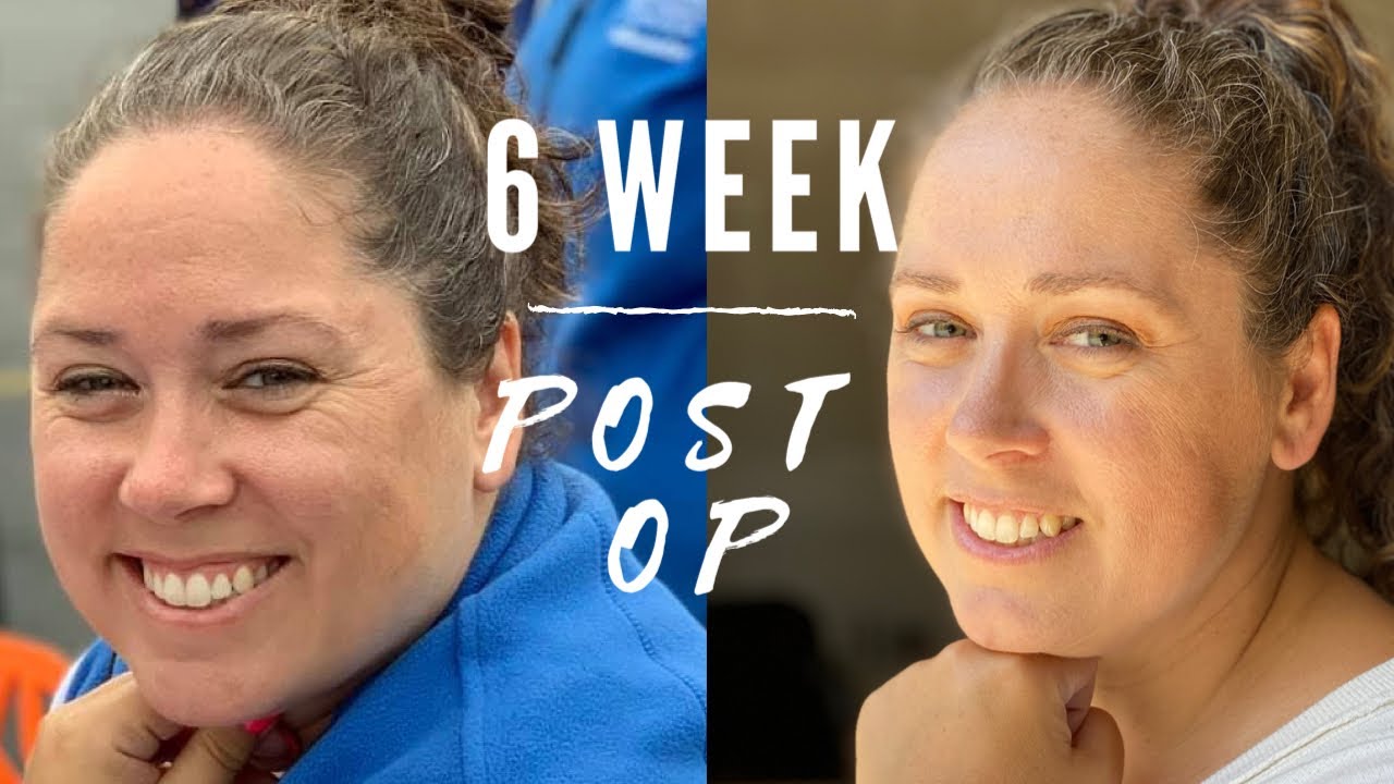 6 Weeks Post Op//Vertical Sleeve Gastrectomy//Why You Should Give The Scale A Rest